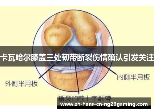 卡瓦哈尔膝盖三处韧带断裂伤情确认引发关注